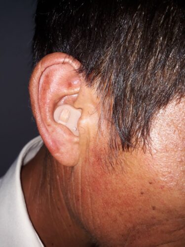 Audífonos Medicados para sordera Modelo Intracanal